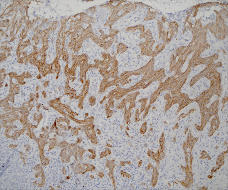 Relationship between androgen receptor and epidermal growth factor receptor determines aggressive behavior of cutaneous basal cell carcinoma.