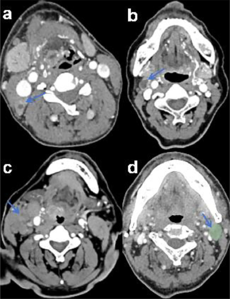 Development and Validation of a Computed Tomography-based Radiomics Nomogram for Diagnosing Cervical Lymph Node Metastasis in Oropharyngeal Squamous Cell Carcinomas.