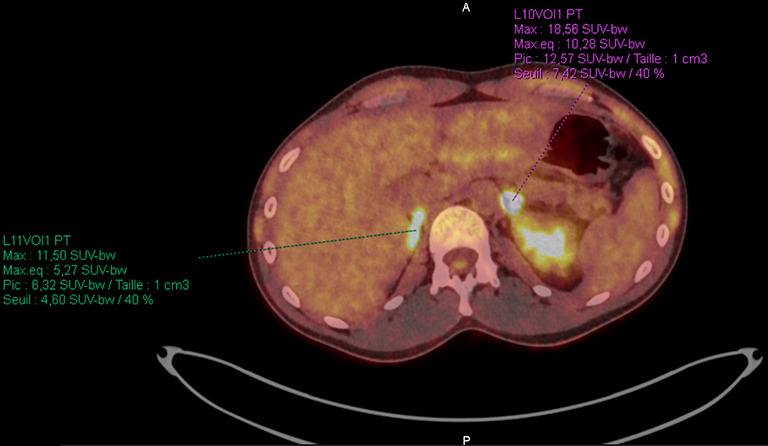 A case report and literature review of a pathologic complete response to alectinib in <i>ALK</i>-positive stage IV non-small cell lung cancer.