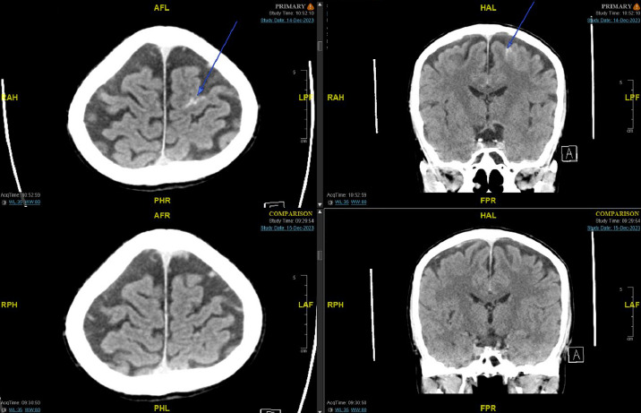 Development of chronic subdural haematoma from mild head injury: A case report and review of current Malaysian guidelines on traumatic brain injury.