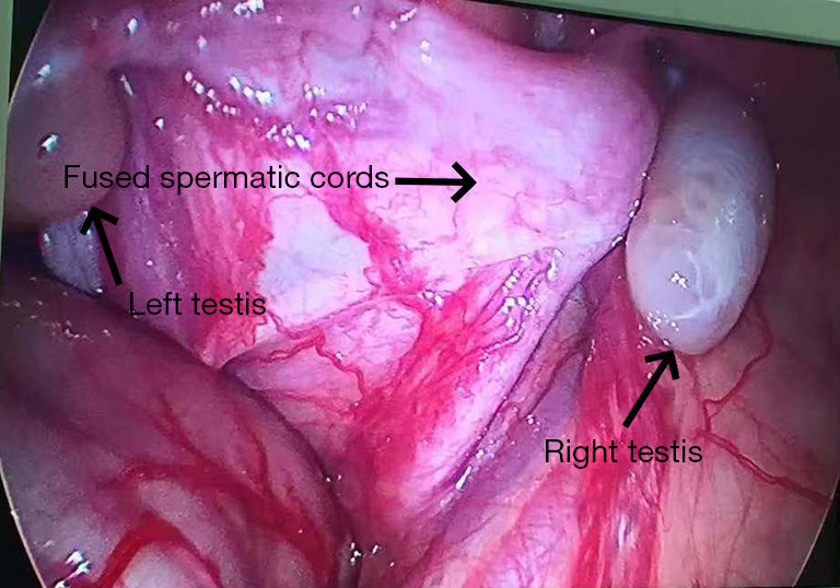Laparoscopic management of transverse testicular ectopia with spermatic cord fusion: a case report.