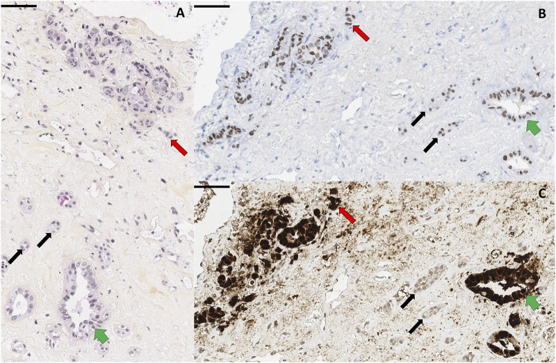 BK Virus: Beyond Nephropathy Metastatic BK Virus-Induced, Donor-Derived Bellini's Carcinoma in a Kidney Allograft Recipient: Boosting Rejection to Treat the Cancer.