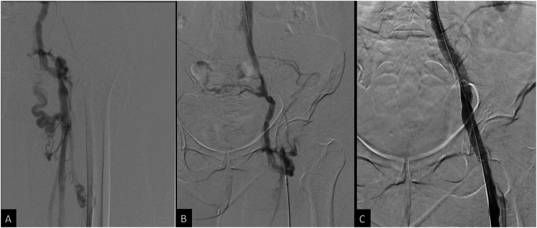 Iliac Artery Occlusion Following Iliac Vein Recanalization and Stenting in Two Patients.