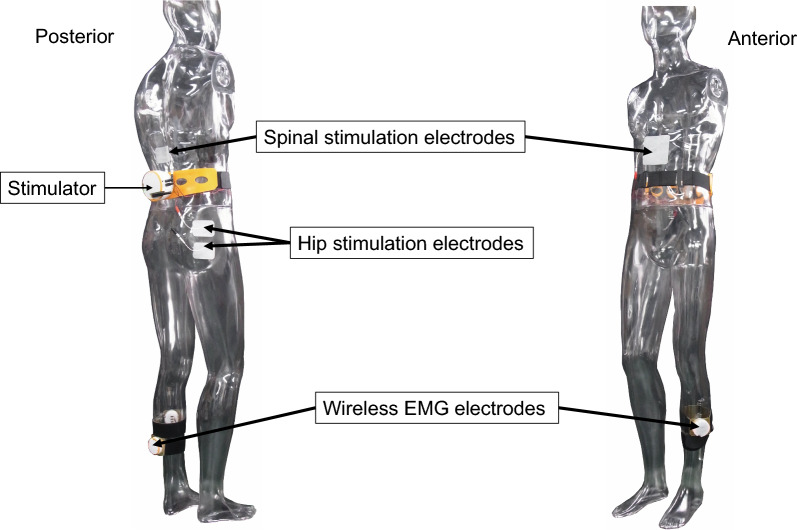 Electromyography (EMG)-triggered transcutaneous spinal cord and hip stimulation for gait rehabilitation in persons with chronic stroke: a randomized, controlled trial.