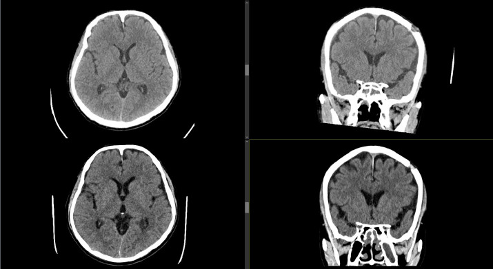Development of chronic subdural haematoma from mild head injury: A case report and review of current Malaysian guidelines on traumatic brain injury.