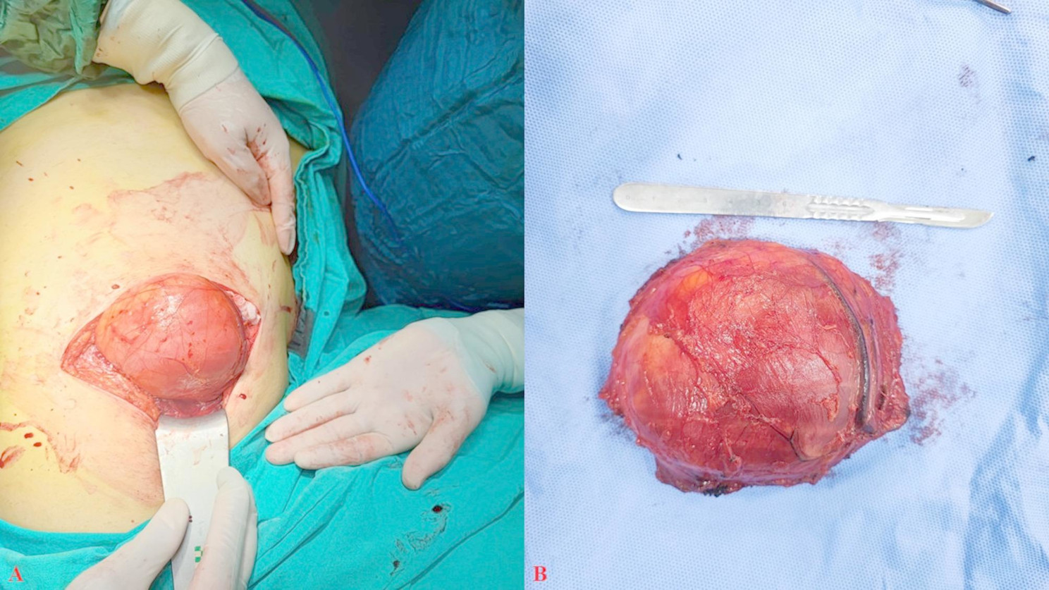 Thoracic outlet syndrome induced by extrathoracic giant lipoma: first case in the literature due to the atypical location.