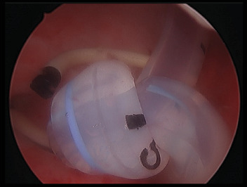 Knotting of a Urinary Catheter and Ureteric Stent: A Unique Complication and Management Solution.