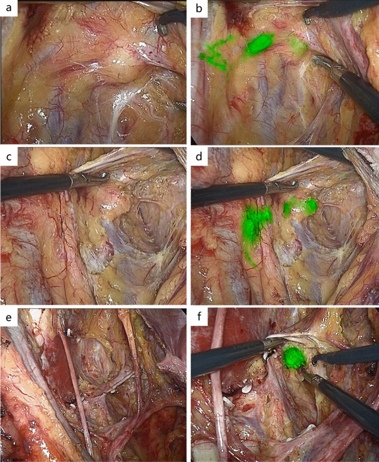Fluorescence lymph node mapping using ICG improves lateral lymph node dissection for mid-low rectal cancer: a propensity score-matched cohort.