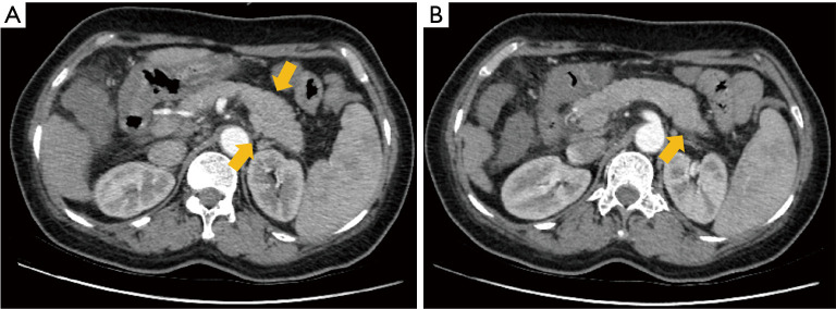 Clinical-CT mismatch in acute pancreatitis: a new concept and report of two cases.