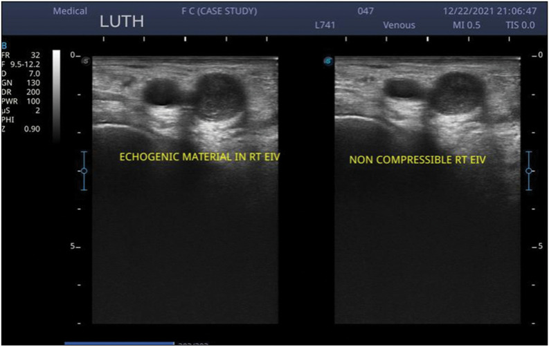 Doppler Ultrasound Evaluation of Lower Extremity Deep Vein Thrombosis in Trauma Patient in Lagos, Nigeria.