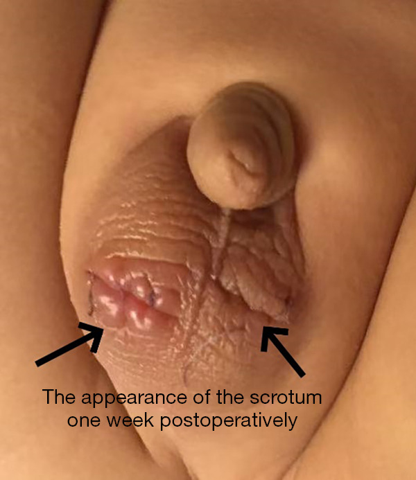 Laparoscopic management of transverse testicular ectopia with spermatic cord fusion: a case report.