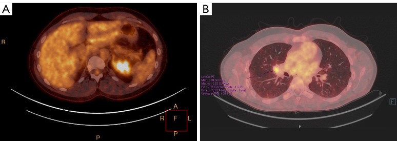 A case report and literature review of a pathologic complete response to alectinib in <i>ALK</i>-positive stage IV non-small cell lung cancer.