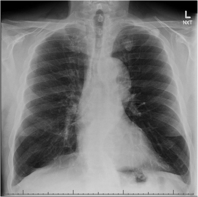 Chronic Marijuana Use and Chronic Obstructive Pulmonary Disease: A Case Report.