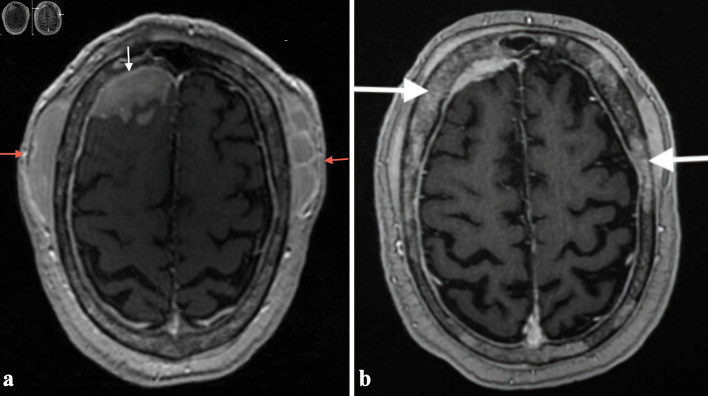 Secondary Central Nervous System Lymphoma Involving Meninges: A Rare Case Report and a Comprehensive Review of Peripheral T-Cell Lymphoma, Not Otherwise Specified.