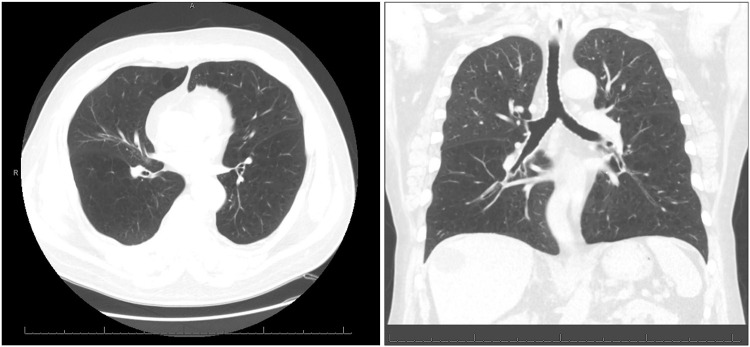Chronic Marijuana Use and Chronic Obstructive Pulmonary Disease: A Case Report.