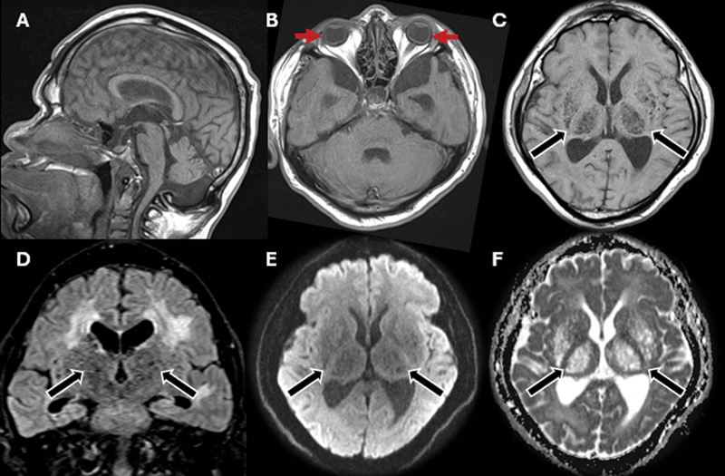 The hidden burden of lysosomal dysfunction: visual decline and microphthalmia in Hunter syndrome.