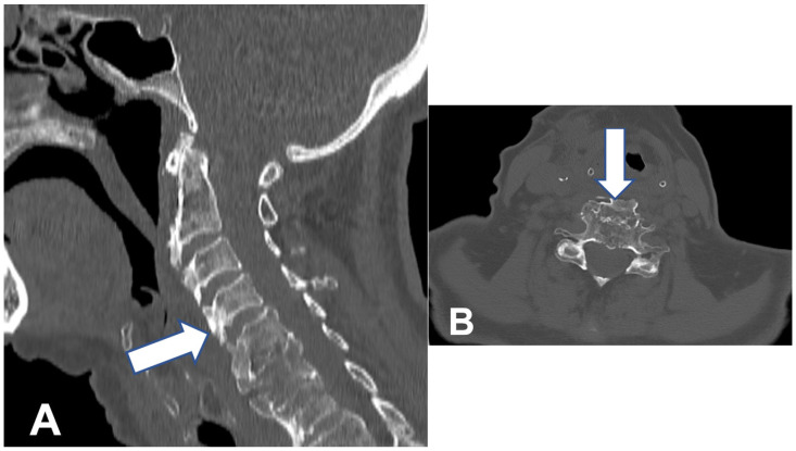 Lifesaving Treatment for DISH Syndrome in the Tenth Decade of Patient's Life.