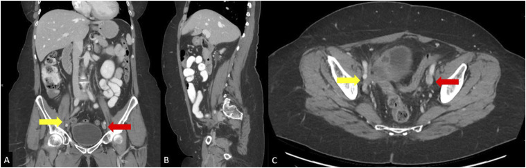 Iliac Artery Occlusion Following Iliac Vein Recanalization and Stenting in Two Patients.