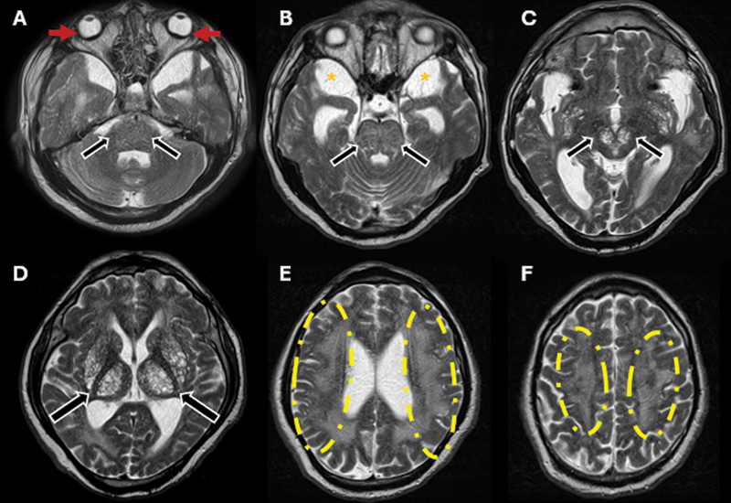 The hidden burden of lysosomal dysfunction: visual decline and microphthalmia in Hunter syndrome.