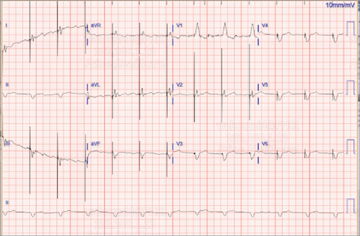 Navigating the Complexities of Mitral Valve Clipping: Early Severe Mitral Valve Stenosis After Mitral Valve Clipping.