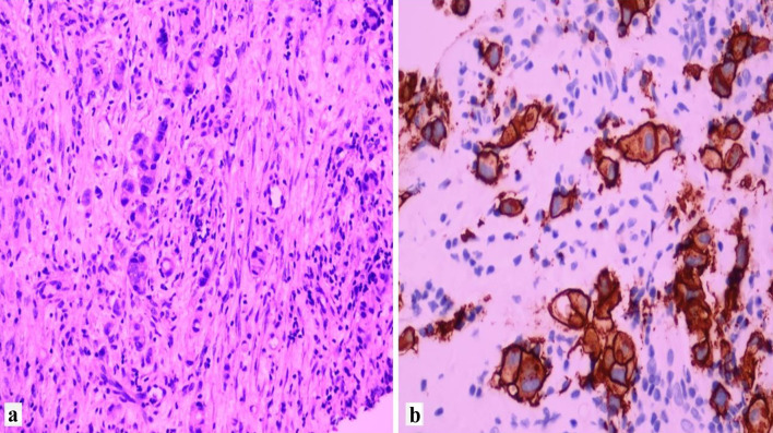 Clinicopathological Features of HER2 Expressing Lobular Carcinoma of Breast.