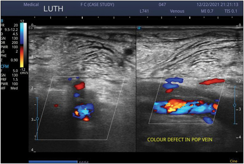 Doppler Ultrasound Evaluation of Lower Extremity Deep Vein Thrombosis in Trauma Patient in Lagos, Nigeria.