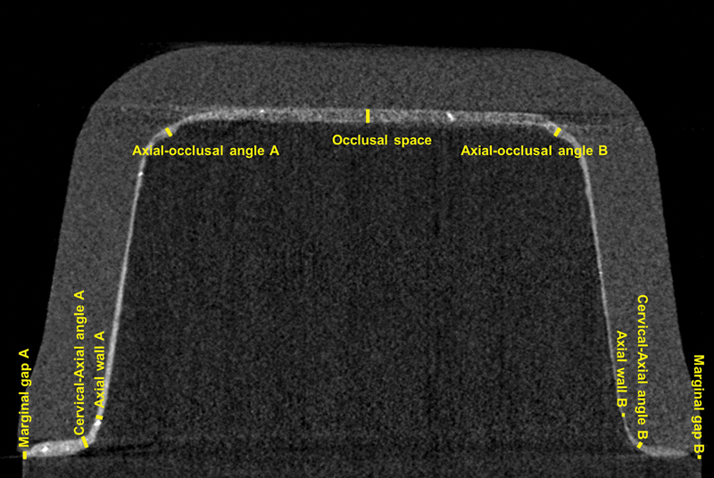 Comparative Analysis of CAD-CAM Workflow Variations on the Marginal and Internal Gaps and Fatigue Behavior of Ceramic and Resin Composite Dental Crowns.