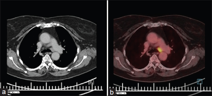 Presentation of sarcoidosis as vocal cord palsy - A case series and review of literature.