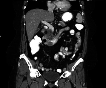Rare Case of Duodenal Metastasis From Colon Cancer: Review of Literature and Insights on Novel Therapies.
