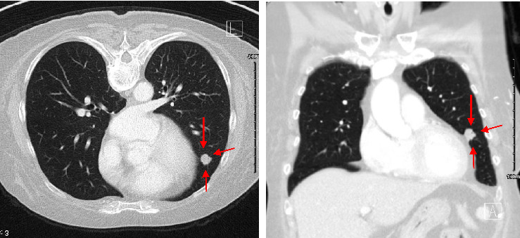 Rare Case of Duodenal Metastasis From Colon Cancer: Review of Literature and Insights on Novel Therapies.