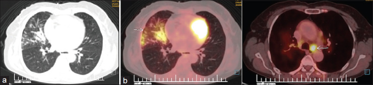 Presentation of sarcoidosis as vocal cord palsy - A case series and review of literature.