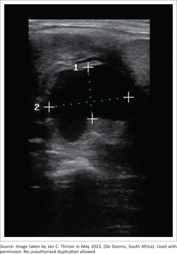 The merit of rural point-of-care ultrasound: Carotid pseudoaneurysm case report.