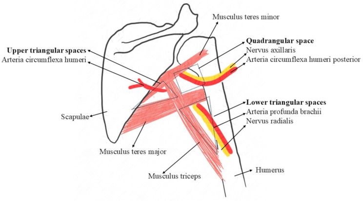 Thoracic outlet syndrome induced by extrathoracic giant lipoma: first case in the literature due to the atypical location.