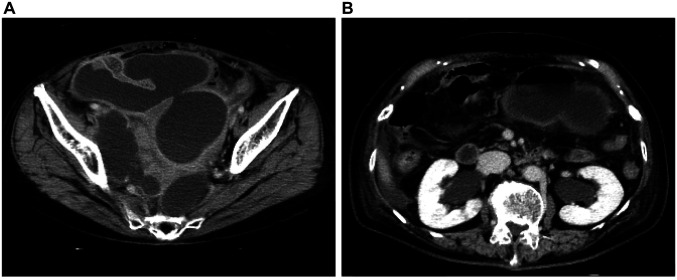 Lymph Cyst After Robotic-assisted Lateral Lymph Node Dissection for Rectal Cancer Treated With Lymphangiography: A Case Report.