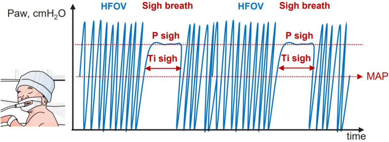 Intermittent sigh breaths during high-frequency oscillatory ventilation among newborn infants.