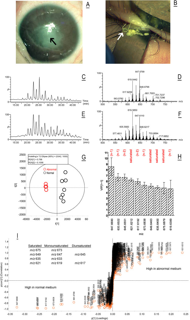 Abnormal Meibum Is Associated With SREBF1 Mutation And IFAP Syndrome-2.