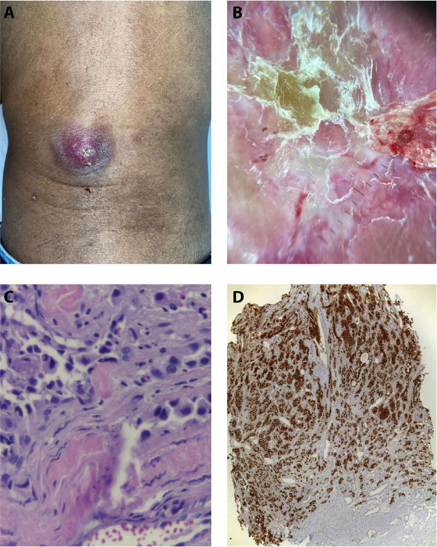 Atypical Cutaneous Metastasis in Clear Cell Renal Carcinoma.