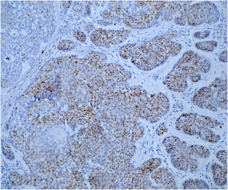 Relationship between androgen receptor and epidermal growth factor receptor determines aggressive behavior of cutaneous basal cell carcinoma.
