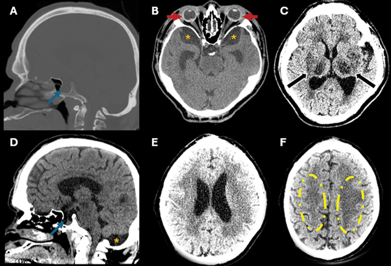 The hidden burden of lysosomal dysfunction: visual decline and microphthalmia in Hunter syndrome.