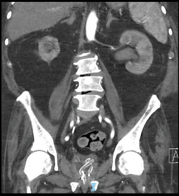 Knotting of a Urinary Catheter and Ureteric Stent: A Unique Complication and Management Solution.
