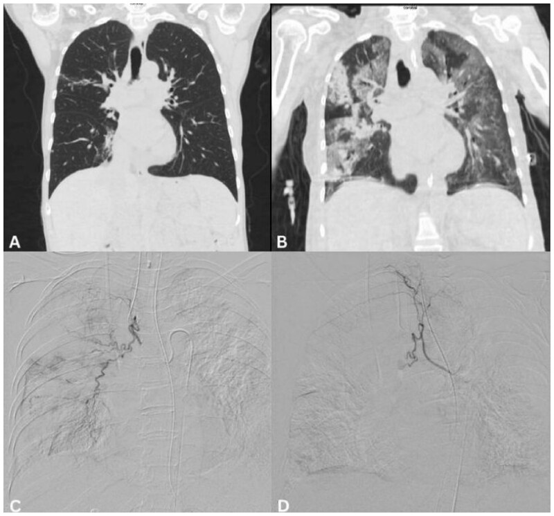 Bronchial artery embolization for haemoptysis in patients with lymphoma and leukaemia.