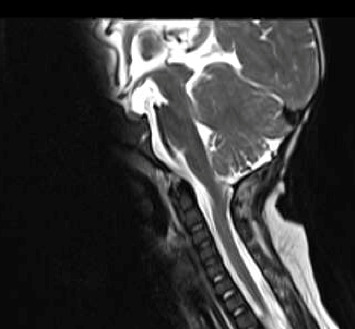 Profound Near Fatal Respiratory Dysfunction in a Neonate With Meningomyelocele: A Narrative With Neurosurgical Lessons.
