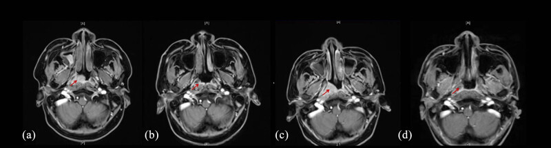 Haplo-hematopoietic stem cell transplantation and immunoradiotherapy for severe aplastic anemia complicated with nasopharyngeal carcinoma: A case report.