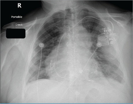 Navigating the Complexities of Mitral Valve Clipping: Early Severe Mitral Valve Stenosis After Mitral Valve Clipping.