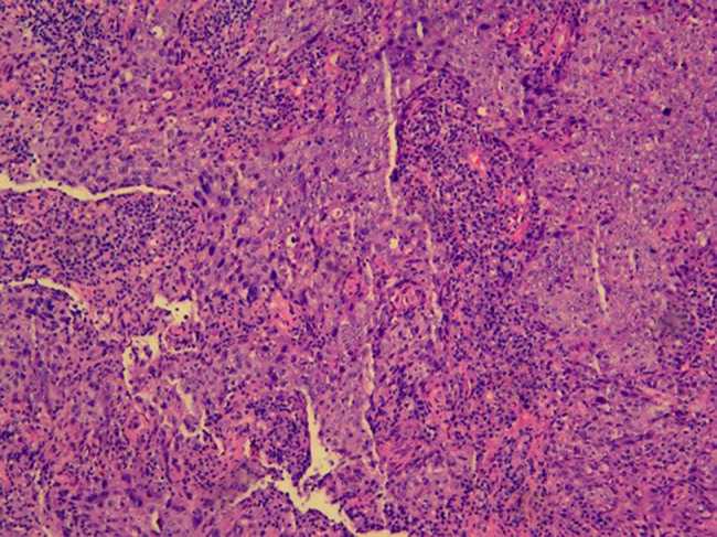 Haplo-hematopoietic stem cell transplantation and immunoradiotherapy for severe aplastic anemia complicated with nasopharyngeal carcinoma: A case report.