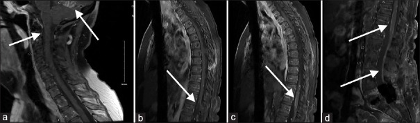 Sugar-Coating or Zuckerguss Appearance on Magnetic Resonance Imaging in Leptomeningeal Carcinomatosis in a Patient with Acute Myeloid Leukemia.