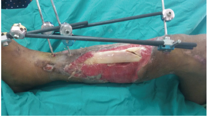Clinical and Functional Outcomes of Ilizarov Bone Transport in Traumatic Tibial Bone Loss.