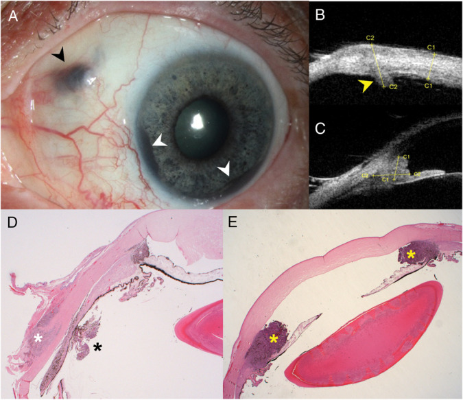 Dissemination of Uveal Melanoma After Diagnostic Biopsy With 23-Gauge Vitrector.