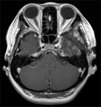 Symptomatic pseudotumor in Meckel cave mimics trigeminal schwannoma.
