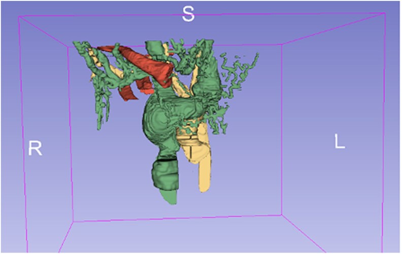 Arteriovenous fistula in the aortic arch: a case report involving 3D models for surgical planning.
